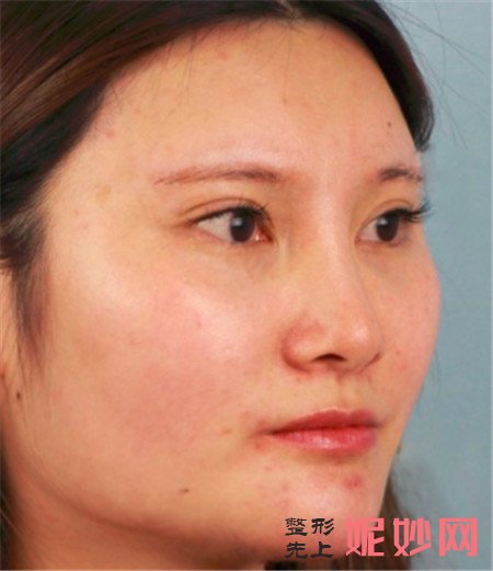 北京八大處（chù）的張智勇醫生做正頜手術怎麽樣？真（zhēn）人案例分享