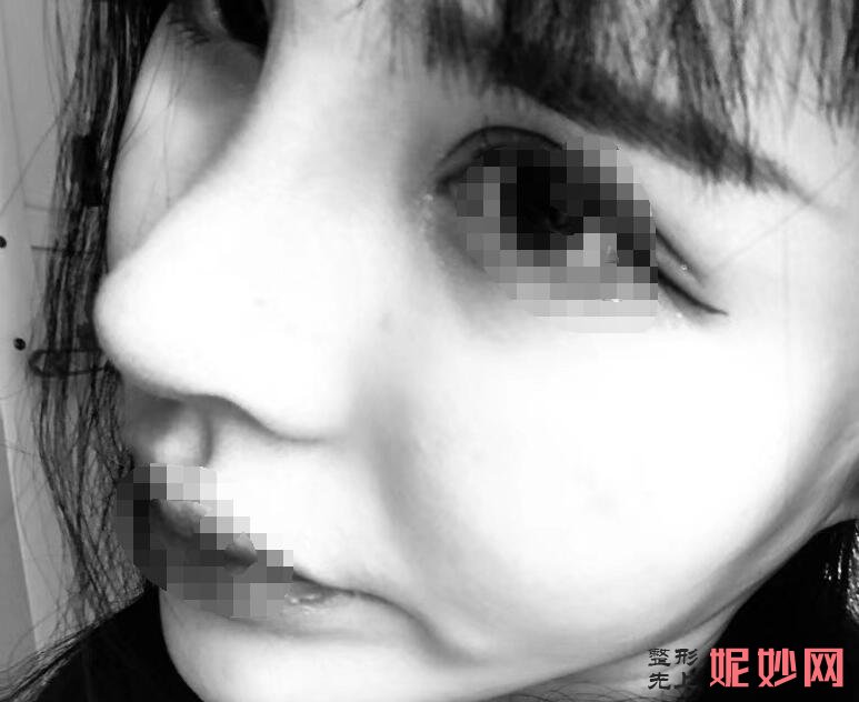 成都聖丹福整形美容醫院張雪峰麵部脂肪填充手術（shù）好不好？擁有少女（nǚ）感！