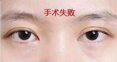 南寧伊晨詳解雙眼（yǎn）皮腫脹、不自（zì）然的原（yuán）因（yīn）