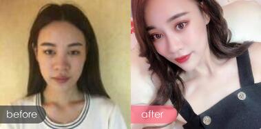 廣州廣美是正規三甲公立醫院嗎?整形會失敗嗎?附真（zhēn）人案例效果_價格表